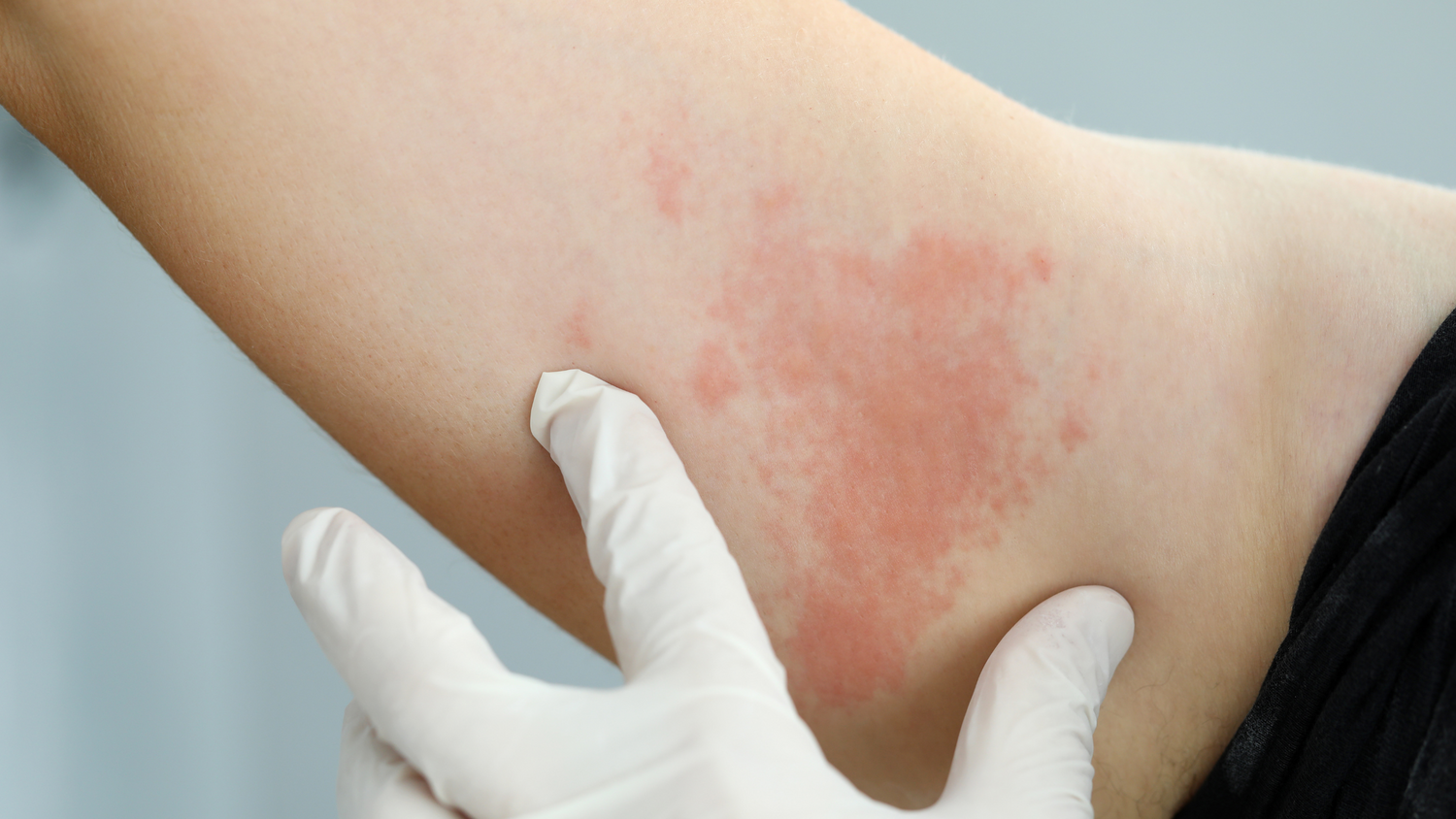 Hisztamin intolerancia okozta bőrpír és viszkető kiütések a karon, orvosi vizsgálat közben.